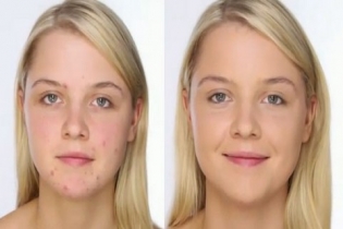 Những chú ý khi chăm sóc da mụn